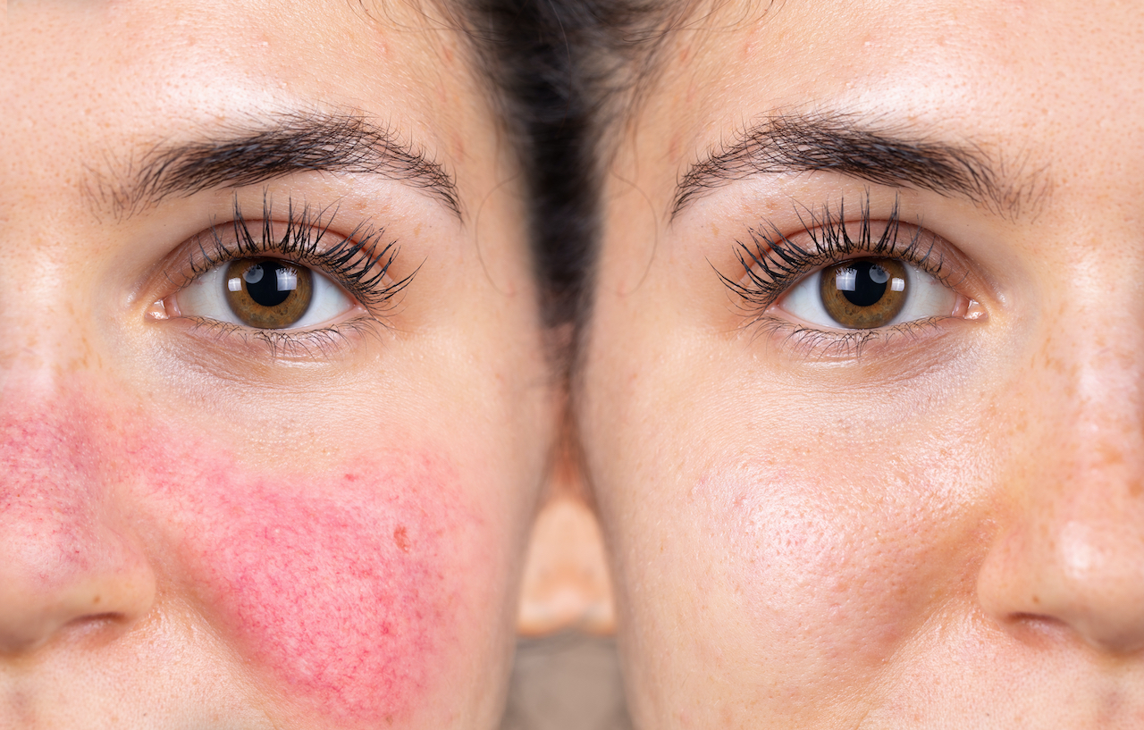 De moderne behandeling van Rosacea