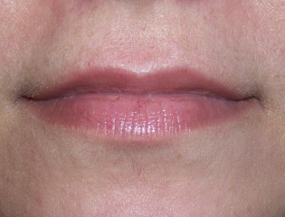 Nationaal Huidcentrum Lipfillers voor meer accent en vollere lippen