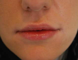 Nationaal Huidcentrum Lipfillers voor meer accent en vollere lippen