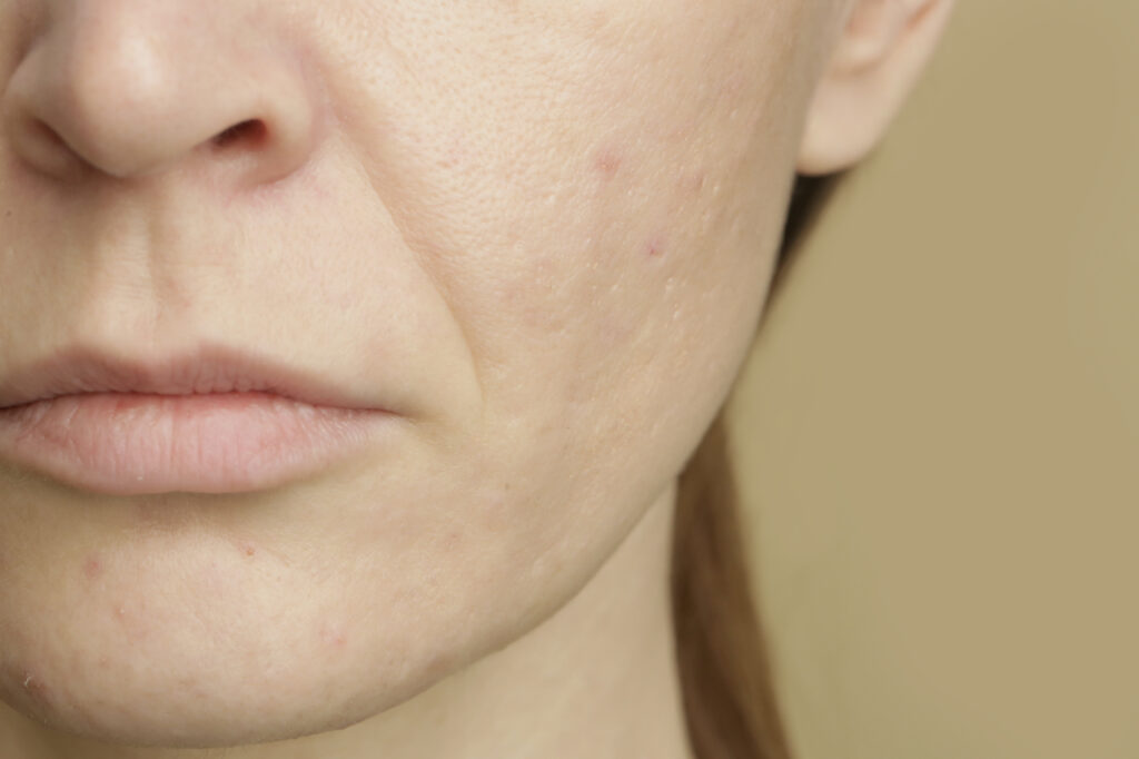 diepe neus lippenplooi opvullen nasolabiale plooi met een filler