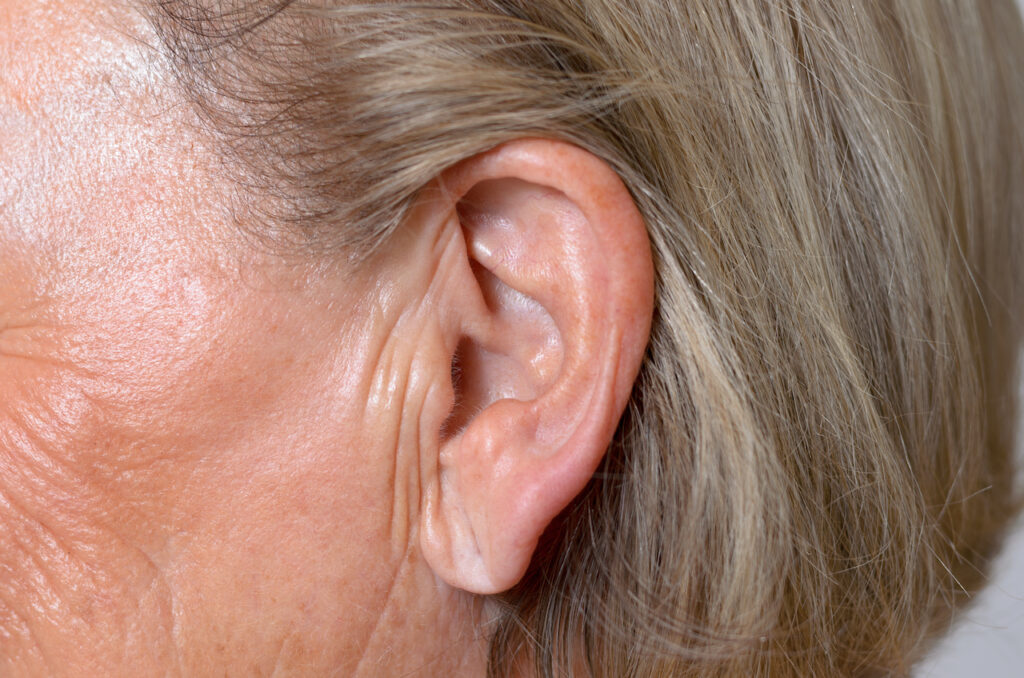 close up van een rimpelige oorlel met volumeverlies van een vrouw van middelbare leeftijd