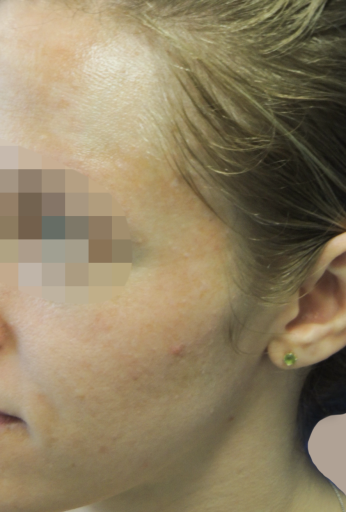 Nationaal Huidcentrum Fractionele CO2 laserbehandeling (laserpeeling)