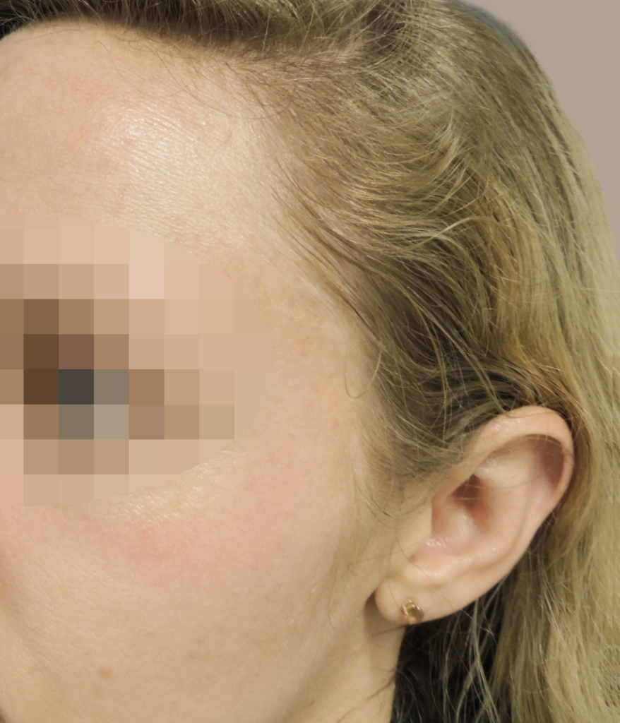 Nationaal Huidcentrum Fractionele CO2 laserbehandeling (laserpeeling)