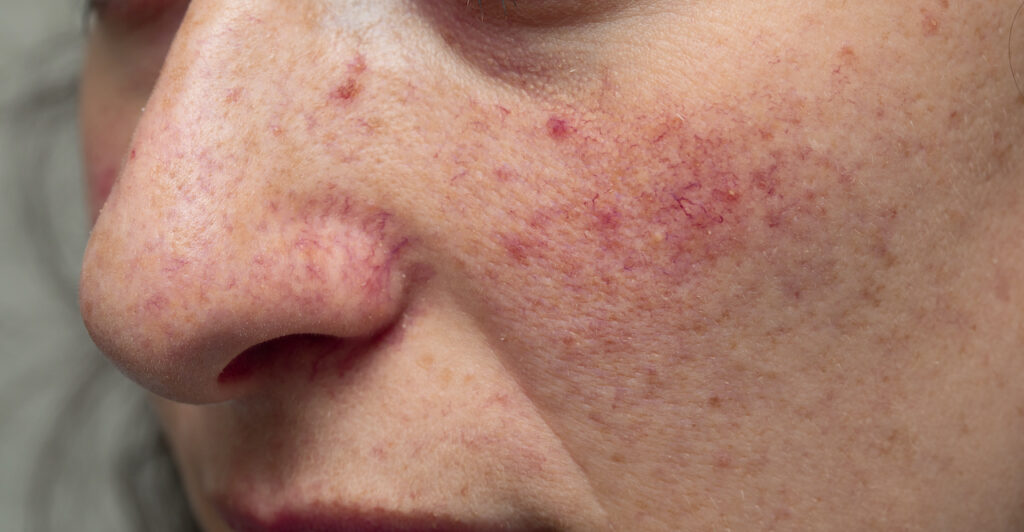 Wang van een jonge vrouw met symptomen van rosacea; roodheid door uitgezette bloedvaatjes, papels en puistjes