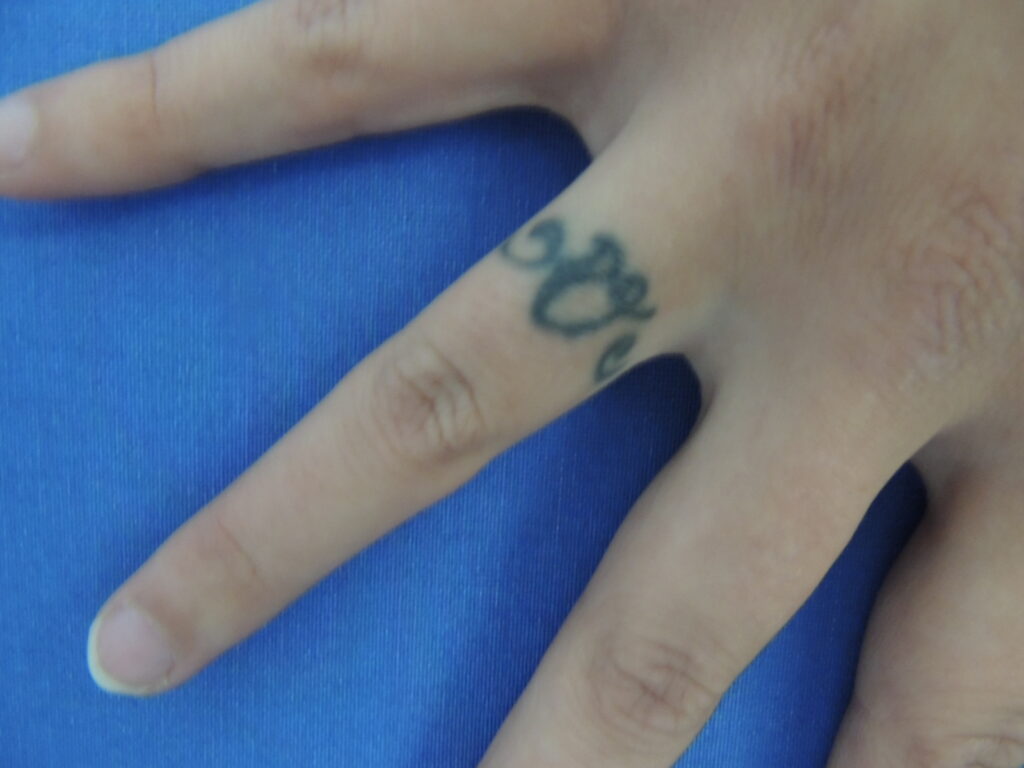 Nationaal Huidcentrum Tatoeage verwijderen: Laat je tattoo verwijderen