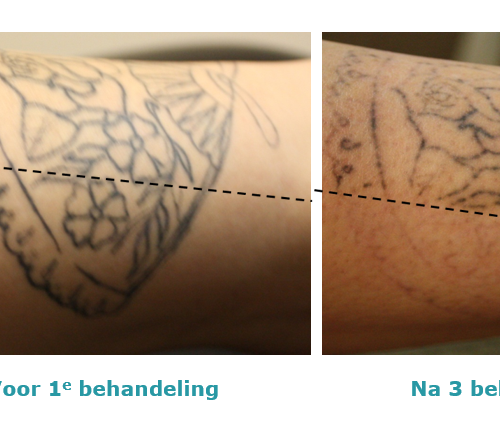 gedeelte van arm met tatoeage voor 1 behandeling en na 3 behandelingen met verschillende lasers