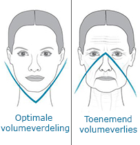 fillers-volumeverlies