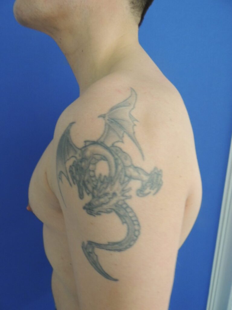 Nationaal Huidcentrum Tatoeage verwijderen: Laat je tattoo verwijderen