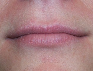 Nationaal Huidcentrum Lipfillers voor meer accent en vollere lippen