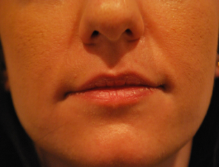 Nationaal Huidcentrum Lipfillers voor meer accent en vollere lippen