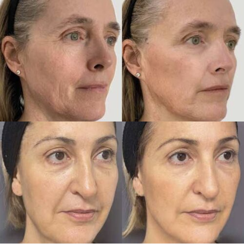 Voor en na foto van een Profhilo Structura behandeling met zichtbaar verbeterde gezichtscontouren en stevigere huid.