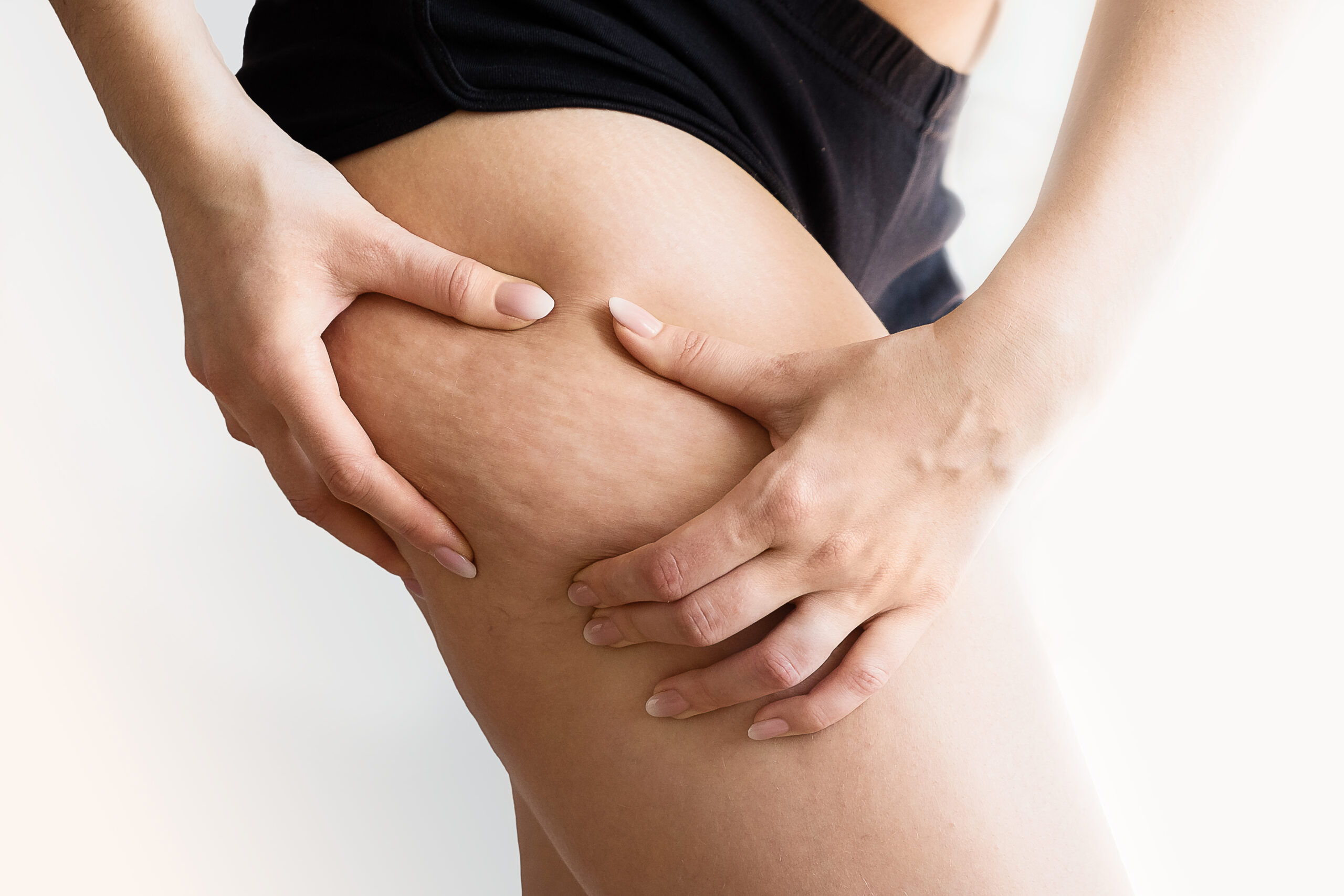 Verschil cellulite en lipoedeem: wat is het?